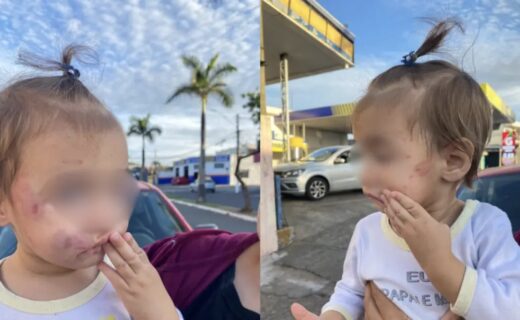 A mãe da criança, Bruna Souza, publicou as fotos dos ferimentos da filha e cobrou ações. Fotos: Reprodução/Redes Sociais ... - Veja mais em https://tododia.com.br/cidades/sumare/bebe-volta-de-creche-de-sumare-com-mordidas-no-rosto-educacao-investiga-o-caso/