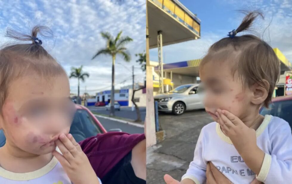 A mãe da criança, Bruna Souza, publicou as fotos dos ferimentos da filha e cobrou ações. Fotos: Reprodução/Redes Sociais ... - Veja mais em https://tododia.com.br/cidades/sumare/bebe-volta-de-creche-de-sumare-com-mordidas-no-rosto-educacao-investiga-o-caso/